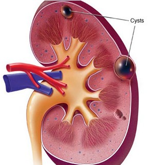 kidney cyst basics
